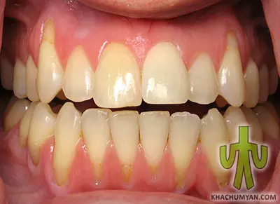 Periodontitis - gum disease