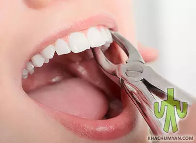 Tooth extraction