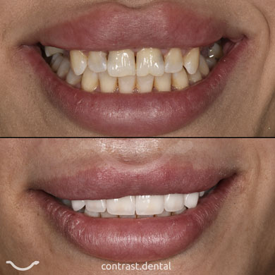 Veneers in Yerevan