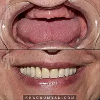KHACHUMYAN Dental Clinic in Yerevan - Before and after - 14