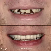 KHACHUMYAN Dental Clinic in Yerevan - Before and after - 3